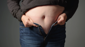 Światowy Dzień Otyłości